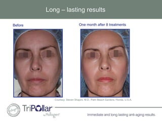 Long – lasting results 
Before One month after 8 treatments 
Courtesy: Steven Shapiro, M.D., Palm Beach Gardens, Florida, U.S.A. 
 