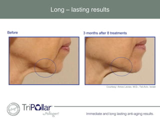 Long – lasting results 
Before 3 months after 8 treatments 
Courtesy: Amos Leviav, M.D., Tel-Aviv, Israel 
 