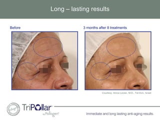 Long – lasting results 
Before 3 months after 8 treatments 
Courtesy: Amos Leviav, M.D., Tel-Aviv, Israel 
 