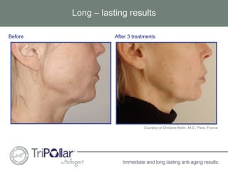 Long – lasting results 
Before After 3 treatments 
Courtesy of Ghislane Beilin, M.D., Paris, France 
 