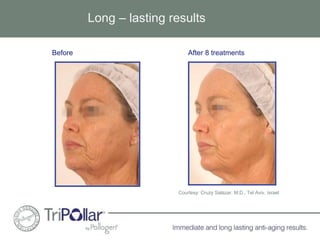 Long – lasting results 
Before After 8 treatments 
Courtesy: Cruzy Salazar, M.D., Tel Aviv, Israel 
 
