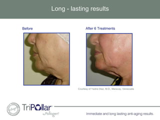 Long - lasting results 
Before After 6 Treatments 
Courtesy of Yadira Diaz, M.D., Maracay, Venezuela 
