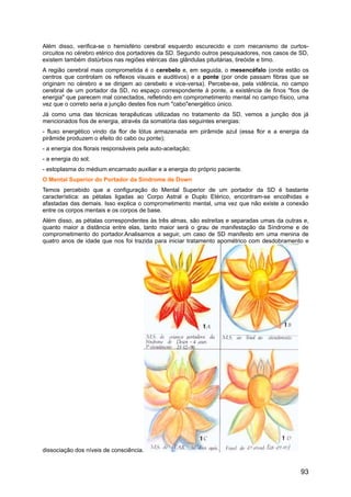 Além disso, verifica-se o hemisfério cerebral esquerdo escurecido e com mecanismo de curtos-
circuitos no cérebro etérico dos portadores da SD. Segundo outros pesquisadores, nos casos de SD,
existem também distúrbios nas regiões etéricas das glândulas pituitárias, tireóide e timo.
A região cerebral mais comprometida é o cerebelo e, em seguida, o mesencéfalo (onde estão os
centros que controlam os reflexos visuais e auditivos) e a ponte (por onde passam fibras que se
originam no cérebro e se dirigem ao cerebelo e vice-versa). Percebe-se, pela vidência, no campo
cerebral de um portador da SD, no espaço correspondente à ponte, a existência de finos "fios de
energia" que parecem mal conectados, refletindo em comprometimento mental no campo físico, uma
vez que o correto seria a junção destes fios num "cabo"energético único.
Já como uma das técnicas terapêuticas utilizadas no tratamento da SD, vemos a junção dos já
mencionados fios de energia, através da somatória das seguintes energias:
- fluxo energético vindo da flor de lótus armazenada em pirâmide azul (essa flor e a energia da
pirâmide produzem o efeito do cabo ou ponte);
- a energia dos florais responsáveis pela auto-aceitação;
- a energia do sol;
- estoplasma do médium encarnado auxiliar e a energia do próprio paciente.
O Mental Superior do Portador da Síndrome de Down
Temos percebido que a configuração do Mental Superior de um portador da SD é bastante
característica: as pétalas ligadas ao Corpo Astral e Duplo Etérico, encontram-se encolhidas e
afastadas das demais. Isso explica o comprometimento mental, uma vez que não existe a conexão
entre os corpos mentais e os corpos de base.
Além disso, as pétalas correspondentes às três almas, são estreitas e separadas umas da outras e,
quanto maior a distância entre elas, tanto maior será o grau de manifestação da Síndrome e de
comprometimento do portador.Analisamos a seguir, um caso de SD manifesto em uma menina de
quatro anos de idade que nos foi trazida para iniciar tratamento apométrico com desdobramento e
dissociação dos níveis de consciência.
93
 