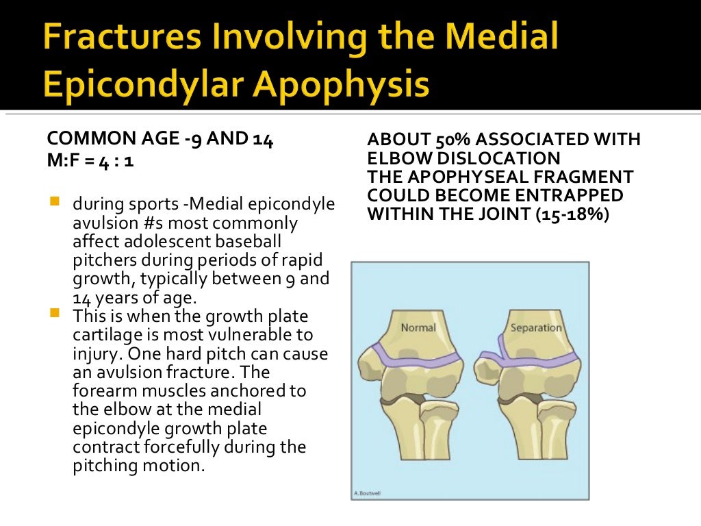 Apophyseal injuries of elbow , medial epicondyle avulsion fractures