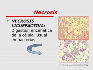 Necrosis
 NECROSIS
  LICUEFACTIVA:
  Digestión enzimática
  de la célula. Usual
  en bacterias




                         www.fcv.unlp.edu.ar/.../Licuefactivax40.jpg
 