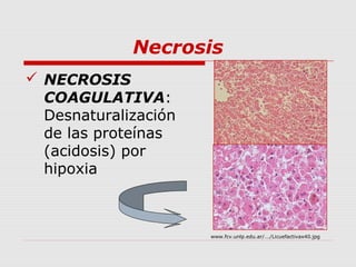 Necrosis
 NECROSIS
  COAGULATIVA:
  Desnaturalización
  de las proteínas
  (acidosis) por
  hipoxia



                      www.fcv.unlp.edu.ar/.../Licuefactivax40.jpg
 