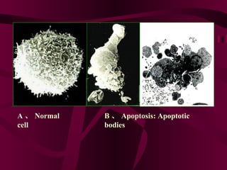 A 、 Normal cell  B 、 Apoptosis: Apoptotic bodies 