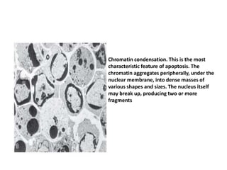Chromatin condensation. This is the most
characteristic feature of apoptosis. The
chromatin aggregates peripherally, under the
nuclear membrane, into dense masses of
various shapes and sizes. The nucleus itself
may break up, producing two or more
fragments
 