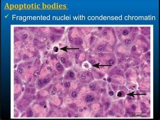Apoptotic bodies
 Fragmented nuclei with condensed chromatin
 