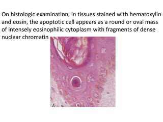 On histologic examination, in tissues stained with hematoxylin
and eosin, the apoptotic cell appears as a round or oval mass
of intensely eosinophilic cytoplasm with fragments of dense
nuclear chromatin
 