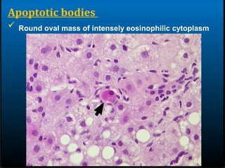 Apoptotic bodies
 Round oval mass of intensely eosinophilic cytoplasm
 