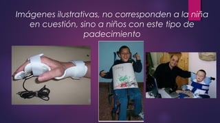 Imágenes ilustrativas, no corresponden a la niña
en cuestión, sino a niños con este tipo de
padecimiento
 
