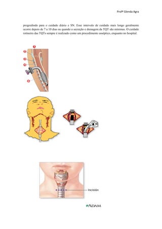 Profª Glenda Agra



progredindo para o cuidado diário e SN. Esse intervalo de cuidado mais longo geralmente
ocorre depois de 7 a 10 dias ou quando a secreção e drenagem da TQT são mínimas. O cuidado
rotineiro das TQTs sempre é realizado como um procedimento asséptico, enquanto no hospital.
 