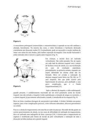 Profª Glenda Agra




Figura 4.

A musculatura prétraqueal (esternoióideo e esternotireóideo) é separada na sua rafe mediana e
afastada, Iateralmente. Na maioria das vezes, o istmo tireoideano é facilmente deslocado
cranialmente por dissecção romba [3]. Eventualmente, pode ser necessário a secção mediana do
istmo com sutura de seus bordos, para melhor exposição da traquéia. Uma incisão horizontal é
então realizada entre o terceiro e quarto anéis traqueais (Fig. 5).

                                              Em crianças, a incisão deve ser realizada
                                              verticalmente. São então passados fios de reparo
                                              em cada lado da abertura traqueal com o intuito
                                              de facilitar a troca da cânula, ou a sua recolocação
                                              em      caso       de     extubação      espontânea,
                                              principalmente, na primeira semana, enquanto um
                                              trajeto delimitado do estoma ainda não foi
                                              formado. Deve ser evitada a realização da
                                              abertura traqueal muito baixa (no 5Q, 6Q, ou 7?
                                              anel traqueal), fato que pode ocorrer pela
                                              hiperextensão do pescoço, pois predispõe a uma
                                              grave      complicação,      que    é     a    fístula
Figura 6.                                     traqueoinominada [13].

                                                Após a abertura da traquéia, o tubo endotraqueal,
quando presente, é cuidadosamente tracionado até um nível justamente acima da incisão
traqueal, mas não retirado; a traquéia é então aspirada para a remoção de sangue ou secreções, e
a cânula traqueal, já previamente selecionada e testada, é introduzida na luz traqueal (Fig. 6).

Deve ser feita a imediata checagem de sua posição e perviedade. A ferida é fechada com pontos
esparsos, para evitar complicações precoces, como enfisema subcutâneo, abscesso periostômico
ou celulite.

Fixa-se a cânula de traqueostomia com uma fita ao redor do pescoço. Havendo dúvida quanto ao
correto posicionamento da cânula, ou nos casos de dificuldade de realização da traqueostomia,
deve ser realizado uma radiografia de tórax e pescoço [14]. A técnica para a traqueostomia na
urgência é modificada pela feitura da incisão da pele verticalmente e realização de toda a
dissecção na linha mediana até a parede traqueal.
 