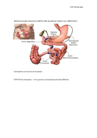 Profª Glenda Agra




Gastroplastia com técnica de Scopinaro



FONTES das ilustrações : www.geocities.com/paulomaciell/index2000.htm
 
