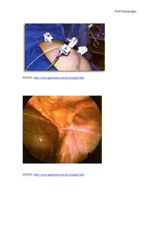 Profª Glenda Agra




FONTE: http://www.gastronet.com.br/cirurgia3.htm




FONTE: http://www.gastronet.com.br/cirurgia3.htm
 