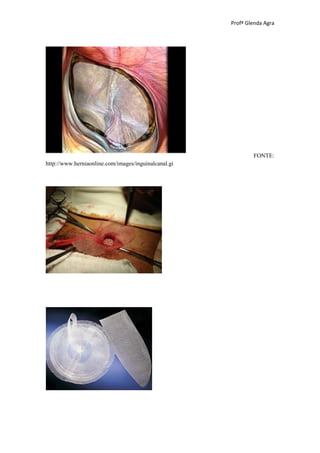Profª Glenda Agra




                                                              FONTE:
http://www.herniaonline.com/images/inguinalcanal.gi
 