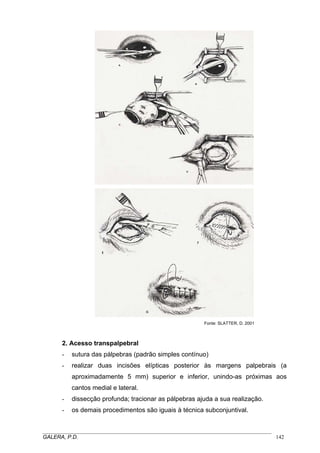 Fonte: SLATTER, D. 2001

2. Acesso transpalpebral
-

sutura das pálpebras (padrão simples contínuo)

-

realizar duas incisões elípticas posterior às margens palpebrais (a
aproximadamente 5 mm) superior e inferior, unindo-as próximas aos
cantos medial e lateral.

-

dissecção profunda; tracionar as pálpebras ajuda a sua realização.

-

os demais procedimentos são iguais à técnica subconjuntival.

_____________________________________________________________________________________
GALERA, P.D.
142

 