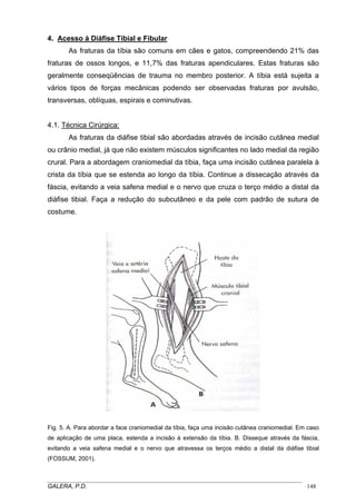 4. Acesso à Diáfise Tibial e Fibular
As fraturas da tíbia são comuns em cães e gatos, compreendendo 21% das
fraturas de ossos longos, e 11,7% das fraturas apendiculares. Estas fraturas são
geralmente conseqüências de trauma no membro posterior. A tíbia está sujeita a
vários tipos de forças mecânicas podendo ser observadas fraturas por avulsão,
transversas, oblíquas, espirais e cominutivas.
4.1. Técnica Cirúrgica:
As fraturas da diáfise tibial são abordadas através de incisão cutânea medial
ou crânio medial, já que não existem músculos significantes no lado medial da região
crural. Para a abordagem craniomedial da tíbia, faça uma incisão cutânea paralela à
crista da tíbia que se estenda ao longo da tíbia. Continue a dissecação através da
fáscia, evitando a veia safena medial e o nervo que cruza o terço médio a distal da
diáfise tibial. Faça a redução do subcutâneo e da pele com padrão de sutura de
costume.

Fig. 5. A. Para abordar a face craniomedial da tíbia, faça uma incisão cutânea craniomedial. Em caso
de aplicação de uma placa, estenda a incisão à extensão da tíbia. B. Disseque através da fáscia,
evitando a veia safena medial e o nervo que atravessa os terços médio a distal da diáfise tibial
(FOSSUM, 2001).

_____________________________________________________________________________________
GALERA, P.D.
148

 