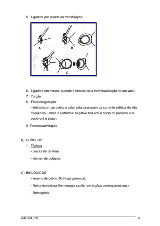 5. Ligadura por laçada ou transfixação:

6. Ligadura em massa: quando é impossível a individualização de um vaso.
7. Torção
8. Eletrocoagulação:
- eletrobisturi: aproveita o calor pela passagem da corrente elétrica de alta
freqüência. Utiliza 2 eletrodos: negativo fica sob o dorso do paciente e o
positivo é o bisturi.
9. Termocauterização

B) QUÍMICOS
1. Tópicos
- perclorato de ferro
- alúmen de potássio

C) BIOLÓGICOS
- veneno de cobra (Bothrops jararaca);
- fibrina esponjosa (hemorragia capilar em órgãos parenquimatosos);
- fibrinogênio.

_____________________________________________________________________________________
GALERA, P.D.
28

 