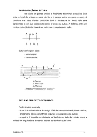 PADRONIZAÇÃO DA SUTURA
Na sutura em pontos simples é importante determinar a distância ideal
entre o local de entrada e saída do fio e o espaço entre um ponto e outro. A
distância A-B deve manter proporção com a espessura do tecido que será
aproximado e com sua capacidade resistir a tensão da sutura. A distância entre um
ponto e outro (A-A) não deverá ser maior que o próprio ponto (A-B).
A

A A

B

B

B

A

B

Sutura em órgãos ocos:
- seromucosa;
- seromuscular.

SUTURAS EM PONTOS SEPARADOS
Ponto simples separado
- é um dos mais usados e é a antiga. É fácil e relativamente rápida de realizar;
- proporciona oclusão anatômica segura e tensão precisa da sutura;
- a agulha é inserida em distância variável de um lado da incisão, cruza a
incisão em ângulo reto e é inserida através do tecido no outro lado;

_____________________________________________________________________________________
GALERA, P.D.
55

 