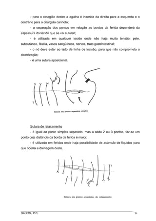 - para o cirurgião destro a agulha é inserida da direita para a esquerda e o
contrário para o cirurgião canhoto;
- a separação dos pontos em relação as bordas da ferida dependerá da
espessura do tecido que se vai suturar;
- é utilizada em qualquer tecido onde não haja muita tensão: pele,
subcutâneo, fáscia, vasos sangüíneos, nervos, trato gastrintestinal;
- o nó deve estar ao lado da linha de incisão, para que não comprometa a
cicatrização;
- é uma sutura aposicional.

Sutura de relaxamento
- é igual ao ponto simples separado, mas a cada 2 ou 3 pontos, faz-se um
ponto cuja distância da borda da ferida é maior;
- é utilizado em feridas onde haja possibilidade de acúmulo de líquidos para
que ocorra a drenagem deste.

_____________________________________________________________________________________
GALERA, P.D.
56

 