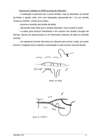 Sutura em U deitado ou Wolff ou ponto de colchoeiro
- a realização é parecida com o ponto simples, mas ao atravessar as bordas
da ferida, a agulha volta, com uma separação aproximada de 1 cm em sentido
inverso ao anterior, unindo-se os cabos;
- provoca a eversão das bordas da ferida;
- são pontos mais fortes que o simples separado, mas a cicatriz é maior;
- é usado para produzir hemostasia e em suturas com tensão (cirurgias de
hérnias, suturas de aponeuroses) ou em ferimentos extensos da pele em grandes
animais;
- em pequenos animais não deve ser utilizado para suturar a pele, por poder
diminuir a irrigação local e retardar a cicatrização ou até provocar necrose tissular.

_____________________________________________________________________________________
GALERA, P.D.
57

 