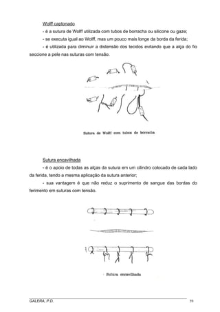 Wolff captonado
- é a sutura de Wolff utilizada com tubos de borracha ou silicone ou gaze;
- se executa igual ao Wolff, mas um pouco mais longe da borda da ferida;
- é utilizada para diminuir a distensão dos tecidos evitando que a alça do fio
seccione a pele nas suturas com tensão.

Sutura encavilhada
- é o apoio de todas as alças da sutura em um cilindro colocado de cada lado
da ferida, tendo a mesma aplicação da sutura anterior;
- sua vantagem é que não reduz o suprimento de sangue das bordas do
ferimento em suturas com tensão.

_____________________________________________________________________________________
GALERA, P.D.
59

 