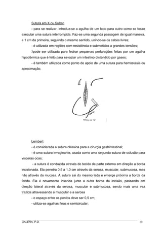 Sutura em X ou Sultan
- para se realizar, introduz-se a agulha de um lado para outro como se fosse
executar uma sutura interrompida. Faz-se uma segunda passagem de igual maneira,
a 1 cm da primeira, seguindo o mesmo sentido, unindo-se os cabos livres;
- é utilizada em regiões com resistência e submetidas a grandes tensões;
3pode ser utilizada para fechar pequenas perfurações feitas por um agulha
hipodérmica que é feito para esvaziar um intestino distendido por gases;
- é também utilizada como ponto de apoio de uma sutura para hemostasia ou
aproximação.

Lembert
- é considerada a sutura clássica para a cirurgia gastrintestinal;
- é uma sutura invaginante, usada como uma segunda sutura de oclusão para
vísceras ocas;
- a sutura é conduzida através do tecido da parte externa em direção a borda
incisionada. Ela penetra 0,5 a 1,0 cm através da serosa, muscular, submucosa, mas
não através da mucosa. A sutura sai do mesmo lado e emerge próxima a borda da
ferida. Ela é novamente inserida junto a outra borda da incisão, passando em
direção lateral através da serosa, muscular e submucosa, sendo mais uma vez
trazida atravessando a muscular e a serosa
- o espaço entre os pontos deve ser 0,5 cm;
- utiliza-se agulhas finas e semicircular;

_____________________________________________________________________________________
GALERA, P.D.
60

 