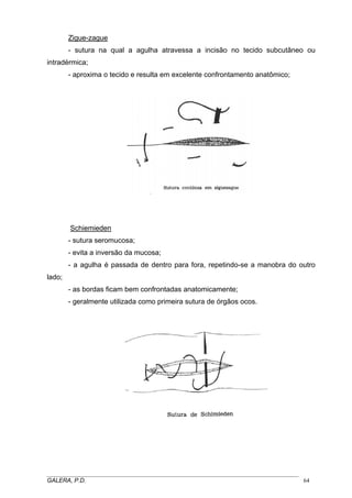Zigue-zague
- sutura na qual a agulha atravessa a incisão no tecido subcutâneo ou
intradérmica;
- aproxima o tecido e resulta em excelente confrontamento anatômico;

Schiemieden
- sutura seromucosa;
- evita a inversão da mucosa;
- a agulha é passada de dentro para fora, repetindo-se a manobra do outro
lado;
- as bordas ficam bem confrontadas anatomicamente;
- geralmente utilizada como primeira sutura de órgãos ocos.

_____________________________________________________________________________________
GALERA, P.D.
64

 