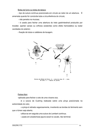 Bolsa de fumo ou bolsa de tabaco
- tipo de sutura contínua posicionada em círculo ao redor de um abertura. É
amarrada quando for concluída toda a circunferência do círculo;
- não penetra na mucosa;
- é usada para fechar uma abertura do trato gastrintestinal produzido por
trocáter, apertar canais ou orifícios existentes como efeito hemostático ou isolar
cavidades do exterior;
- fixação de tubos e catéteres de lavagem.

Parker-Kerr
-aplicada para fechar o coto de uma víscera oca;
-é a sutura de Cushing realizada sobre uma pinça posicionada na
extremidade do coto;
- a pinça é retirada vagarosamente, invertendo as bordas do ferimento sem
que o lúmen seja aberto;
-utiliza-se em seguida uma sutura de Lembert contínua;
- usada em anastomose jejuno-cecal no cavalo, íleo terminal.

_____________________________________________________________________________________
GALERA, P.D.
66

 