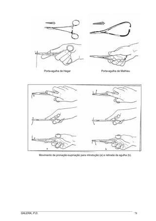 Porta-agulha de Hegar

Porta-agulha de Mathieu

Movimento de pronação-supinação para introdução (a) e retirada da agulha (b).

_____________________________________________________________________________________
GALERA, P.D.
78

 
