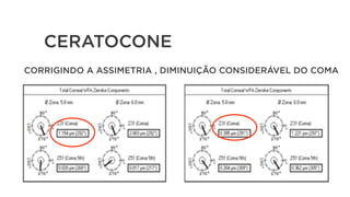 CERATOCONE
CORRIGINDO A ASSIMETRIA , DIMINUIÇÃO CONSIDERÁVEL DO COMA
 