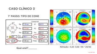 CASO CLÍNICO 3
Qual anel?
Refração: -4,25 -3,50 135 ° 20/30
.................
1° PASSO: TIPO DE CONE
Qual
o
anel?
160°
 