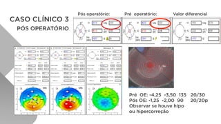 CASO CLÍNICO 3
PÓS OPERATÓRIO
Pré OE: -4,25 -3,50 135 20/30
Pós OE: -1,25 -2,00 90 20/20p
Observar se houve hipo
ou hipercorreção
Pós operatório: Pré operatório: Valor diferencial
 