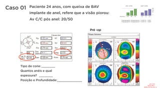 Caso 01
Tipo de cone:
Quantos anéis e qual
espessura?
Posição e Profundidade:
.................
.................
...............................
Pré -op
Paciente 24 anos, com queixa de BAV
implante de anel, refere que a visão piorou:
Av C/C pós anel: 20/50
R:	Tipo	de	cone:	Nipple	
						1	seg	210/20	
						eixo:	110°	
 