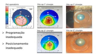 Ø  Programação
inadequada
Pré operatório Pós op 1° cirurgia Pós op 1° cirurgia
Pós op 2° cirurgia Pós op 2° cirurgia
Ø  Posicionamento
inadequado
 