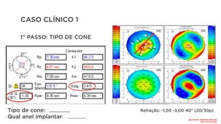 CASO CLÍNICO 1
Tipo de cone:
Qual anel implantar: ................
1° PASSO: TIPO DE CONE
Refração: -1,00 -3,00 40° (20/30p)
.................
Tipo
de
cone:
oval
Qual
anel
implantar:
anel
de
160	
 