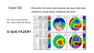 Caso 02: •  Paciente 44 anos com queixa de que não teve
melhora visual após implante de anel
OD +1,0 -2,25 60 20/20
OE: -2,00 -4,00 140 20/50
O QUE FAZER?
 