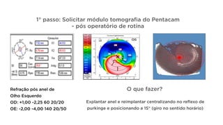 Caso 2:
1° passo: Solicitar módulo tomografia do Pentacam
- pós operatório de rotina
O que fazer?
Explantar anel e reimplantar centralizando no reflexo de
purkinge e posicionando a 15° (giro no sentido horário)
Refração pós anel de
Olho Esquerdo
OD: +1,00 -2,25 60 20/20
OE: -2,00 -4,00 140 20/50
 