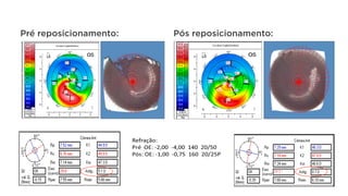 Pré reposicionamento: Pós reposicionamento:
 