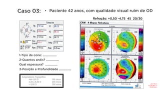 Refração: +0,50 -4,75 45 20/30
1-Tipo de cone: .................
2-Quantos anéis? ................
Qual espessura? ...............
3-Posição e Profundidade ...............
•  Paciente 42 anos, com qualidade visual ruim de OD
Caso 03:
1-Pelícida	like	
2-	1	seg	140°/15	
3-	Eixo:	142°	
 