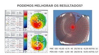 PODEMOS MELHORAR OS RESULTADOS?
PRÉ OD: +0,50 -4,75 45 20/30 Q: -0,29 ASTIG: 3,1
PÓS OD: +1,00 -2,50 80 20/25 Q: 0,05 ASTIG: 3,7
 