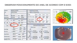 OBSERVAR POSICIONAMENTO DO ANEL DE ACORDO COM O EIXO:
 