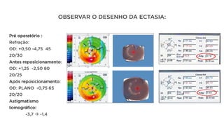 OBSERVAR O DESENHO DA ECTASIA:
Pré operatório :
Refração:
OD: +0,50 -4,75 45
20/30
Antes reposicionamento:
OD: +1,25 -2,50 80
20/25
Após reposicionamento:
OD: PLANO -0,75 65
20/20
Astigmatismo
tomográfico:
-3,7 à -1,4
 