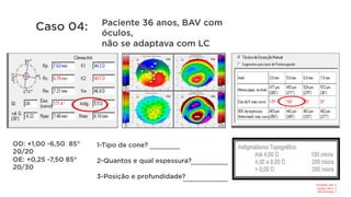 1-Tipo de cone?
2-Quantos e qual espessura?
3-Posição e profundidade?
OD: +1,00 -6,50 85°
20/20
OE: +0,25 -7,50 85°
20/30
.................
.....................
.........................
Paciente 36 anos, BAV com
óculos,
não se adaptava com LC
Caso 04:
1-	Pellúcida	Like	
2-	1	seg		140/20	
3-	165°	442micra	
 