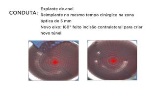CONDUTA:
Explante de anel
Reimplante no mesmo tempo cirúrgico na zona
óptica de 5 mm
Novo eixo: 180° feito incisão contralateral para criar
novo túnel
 