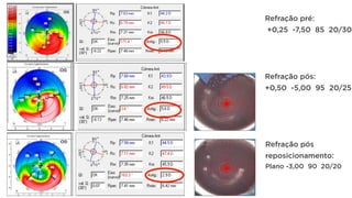 Refração pré:
+0,25 -7,50 85 20/30
Refração pós:
+0,50 -5,00 95 20/25
Refração pós
reposicionamento:
Plano -3,00 90 20/20
 