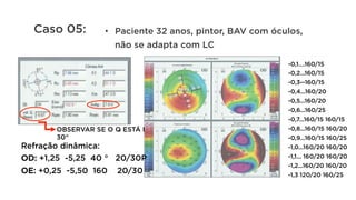 •  Paciente 32 anos, pintor, BAV com óculos,
não se adapta com LC
OBSERVAR SE O Q ESTÁ EM
30°
-0,1….160/15
-0,2...160/15
-0,3--160/15
-0,4...160/20
-0,5...160/20
-0,6...160/25
-0,7...160/15 160/15
-0,8...160/15 160/20
-0,9...160/15 160/25
-1,0...160/20 160/20
-1,1... 160/20 160/20
-1,2...160/20 160/20
-1,3 120/20 160/25
Caso 05:
Refração dinâmica:
OD: +1,25 -5,25 40 ° 20/30P
OE: +0,25 -5,50 160 20/30
 