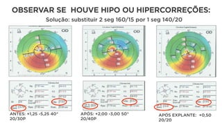OBSERVAR SE HOUVE HIPO OU HIPERCORREÇÕES:
ANTES: +1,25 -5,25 40°
20/30P
APÓS: +2,00 -3,00 50°
20/40P
APÓS EXPLANTE: +0,50
20/20
Solução: substituir 2 seg 160/15 por 1 seg 140/20
 